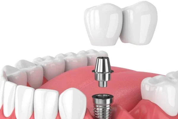 Fixed-prosthesis-640x480