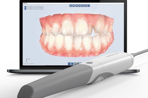 Scanner Intraorale