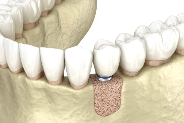 implantologia-senza-osso